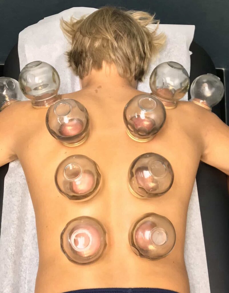 Fire Cupping for Muscle Tension, Exercise and Workout Recovery, Improving Circulation, Detox, Relaxation